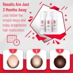 Regenivade – מינוקסידיל 5% קצף + ביוטין אספקה לשישה חודשים – התכשיר המתקדם ביותר!