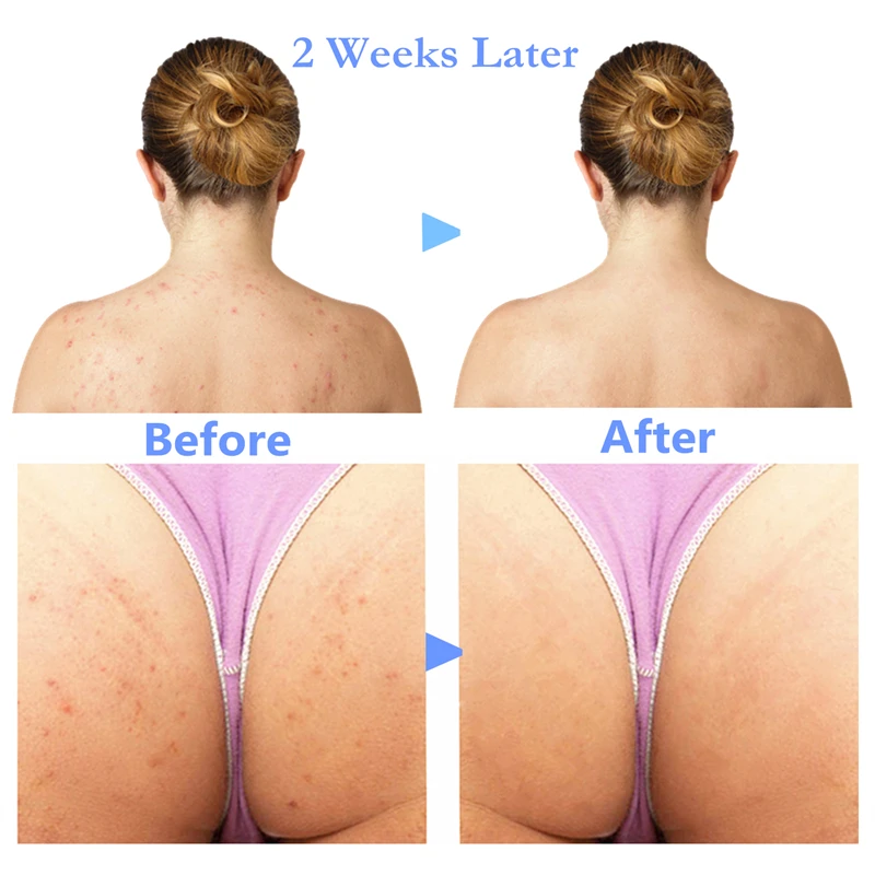 קרם לטיפול באקנה בגוף