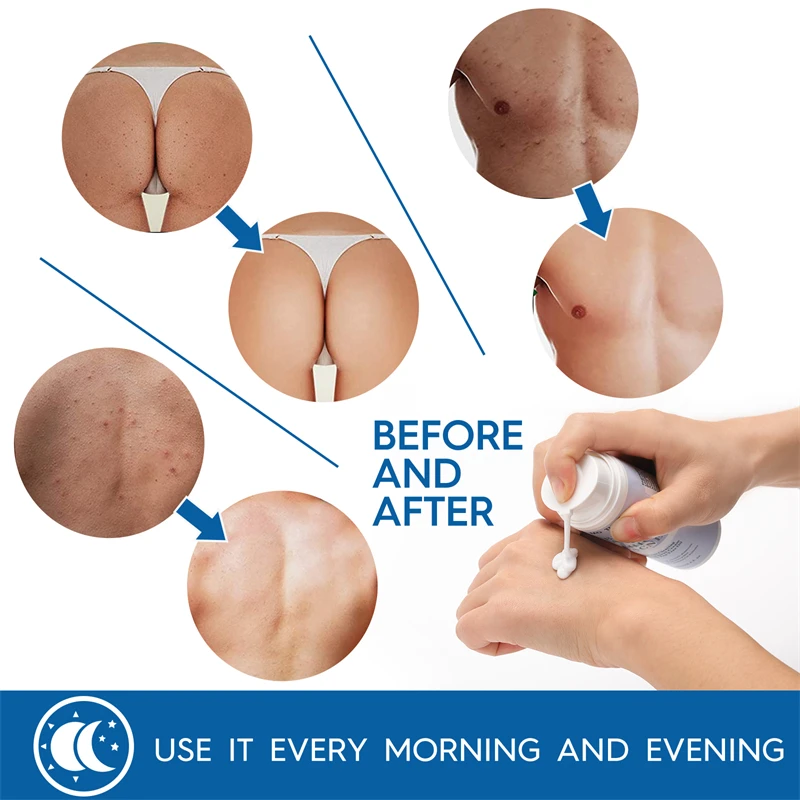 קרם לטיפול באקנה בגוף