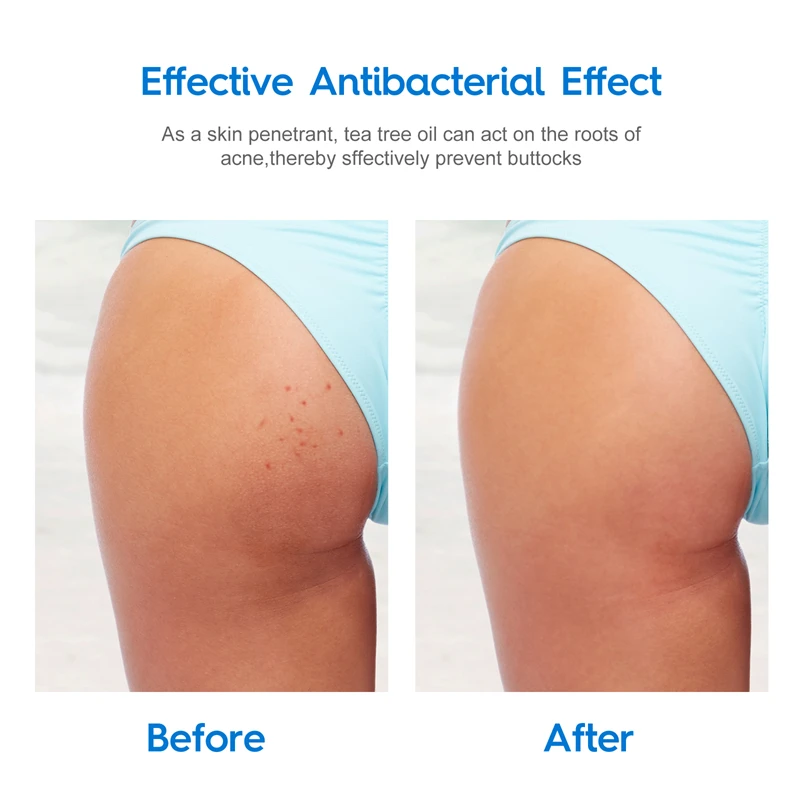 קרם לטיפול באקנה בגוף