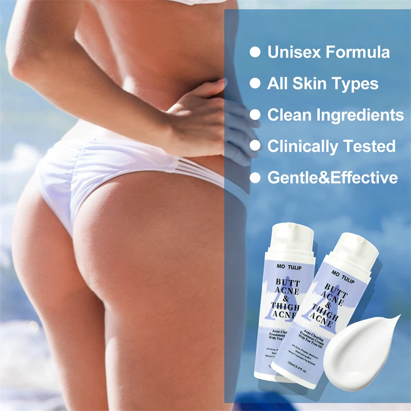 קרם לטיפול באקנה בגוף